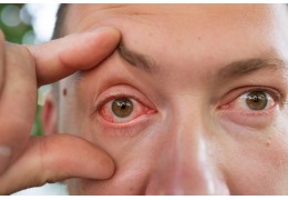 Enrojecimiento de los ojos: causas y cómo evitarlo